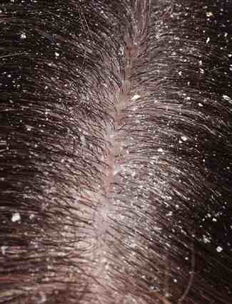 Dandruff